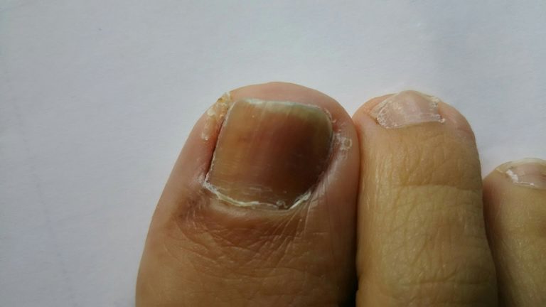 Q&A: ランニングで足の爪が黒くなる